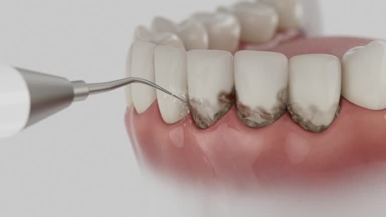 Reliable Dental Implants contractor in Clinton, MO by Smile Center Dentistry
